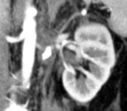 Ruptured renal artery aneurysm